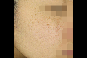 피부레이저(기미, 주근깨)