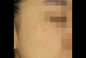 피부레이저(기미, 주근깨)