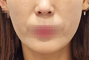 하안면필러