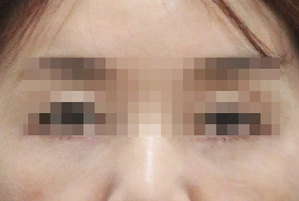 눈밑 필러