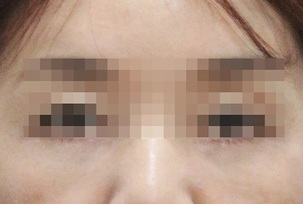 눈밑 필러