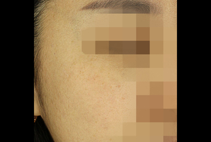 피부레이저(기미, 주근깨)
